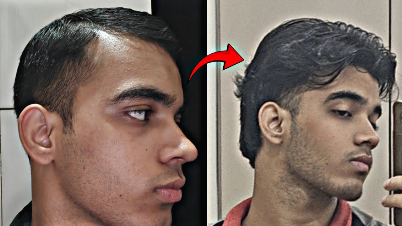 My Hairloss Reverse Story 
