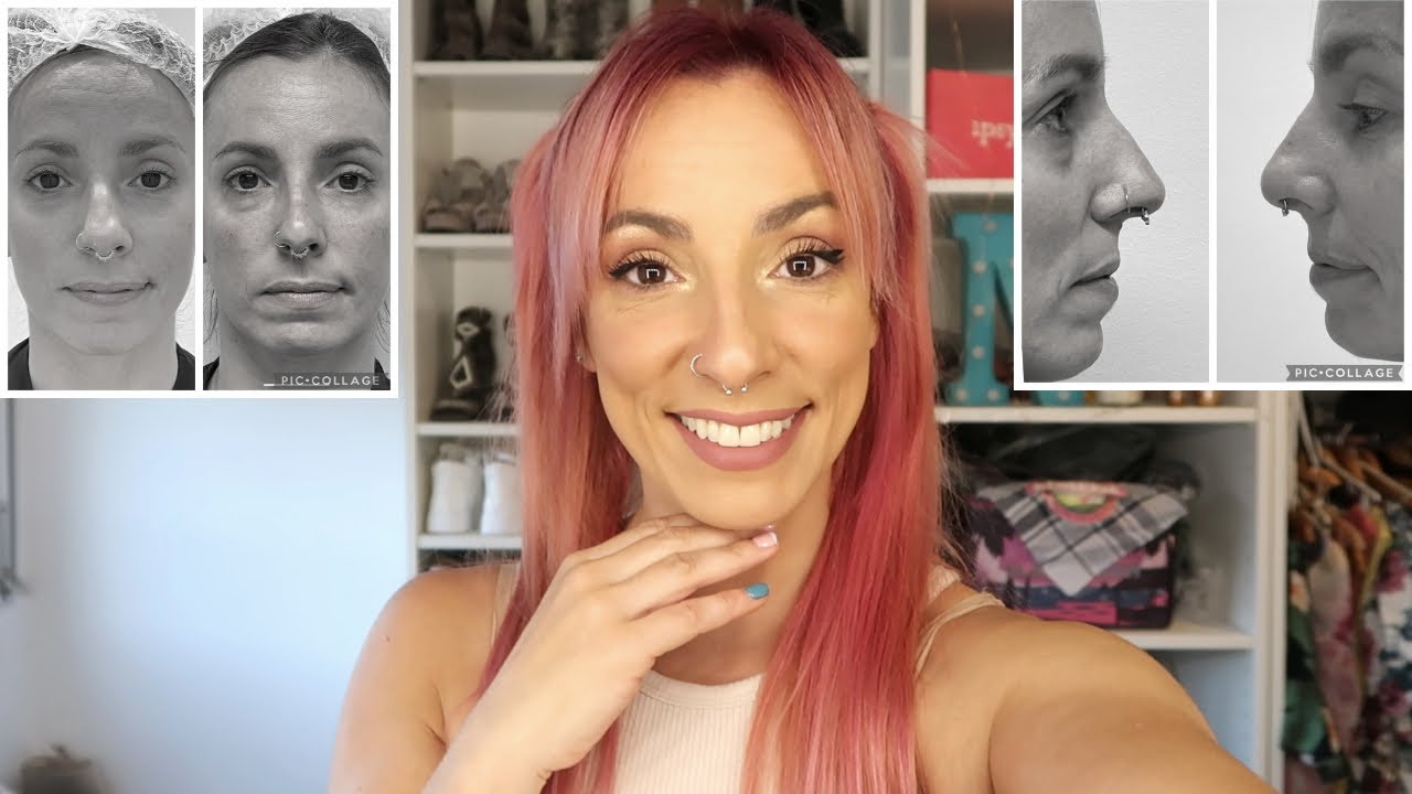 Rinomodelación y relleno de ojeras | Mi experiencia y primeras impresiones