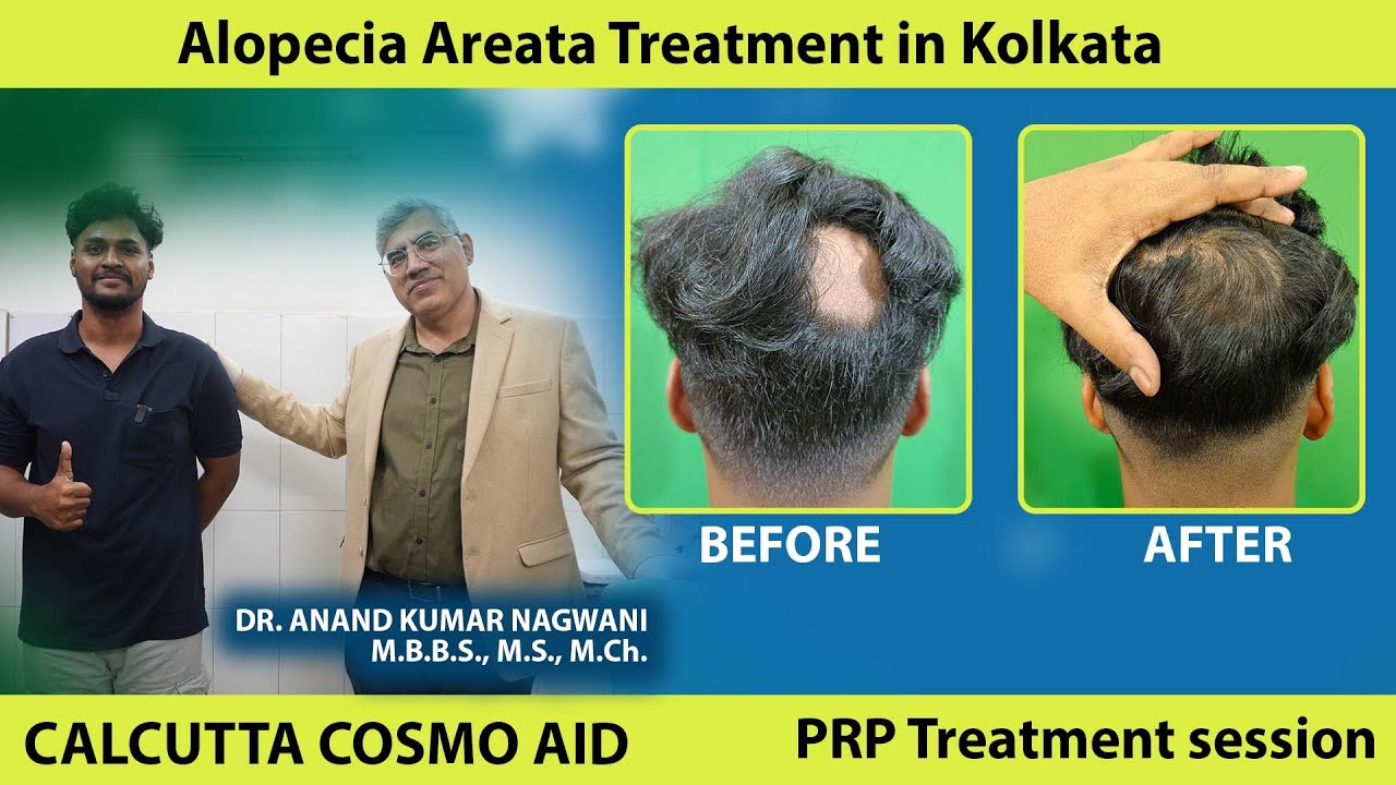 Alopecia areata treatment in Kolkata | PRP Treatment session | Before and After | Cosmo aid