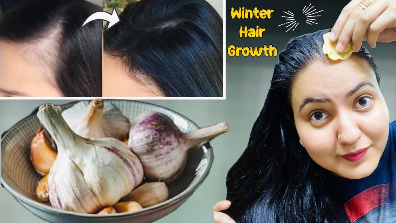 30 Days *Hairline Regrowth* Challenge : Cure Receding Hairline, Bald Patches Naturally At Home❤️