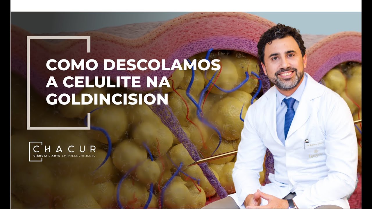 Como descolamos a celulite com GoldIncision | Removing Cellulite with GoldIncision