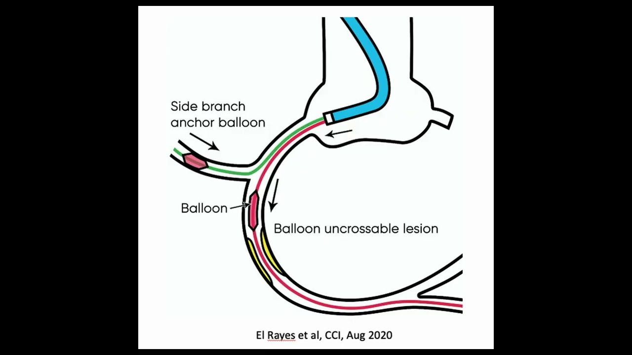 Practice Tips with Dr. Lichaa: Conus Branch Significance