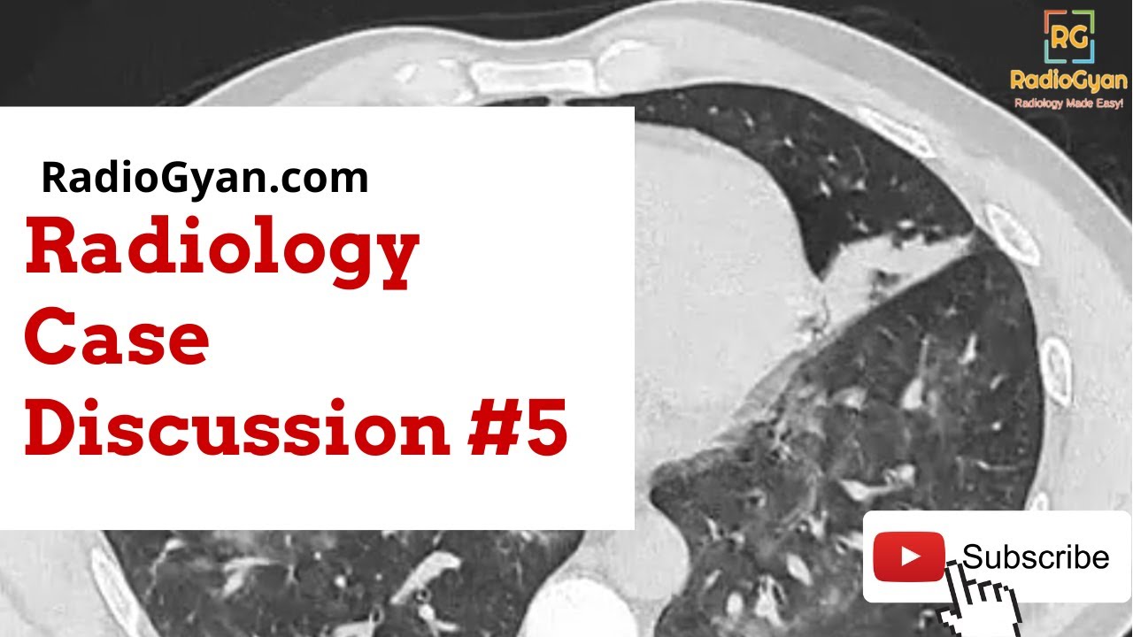 Hemoptysis - Role of Imaging (Case-based approach) | Radiology Board Review Case