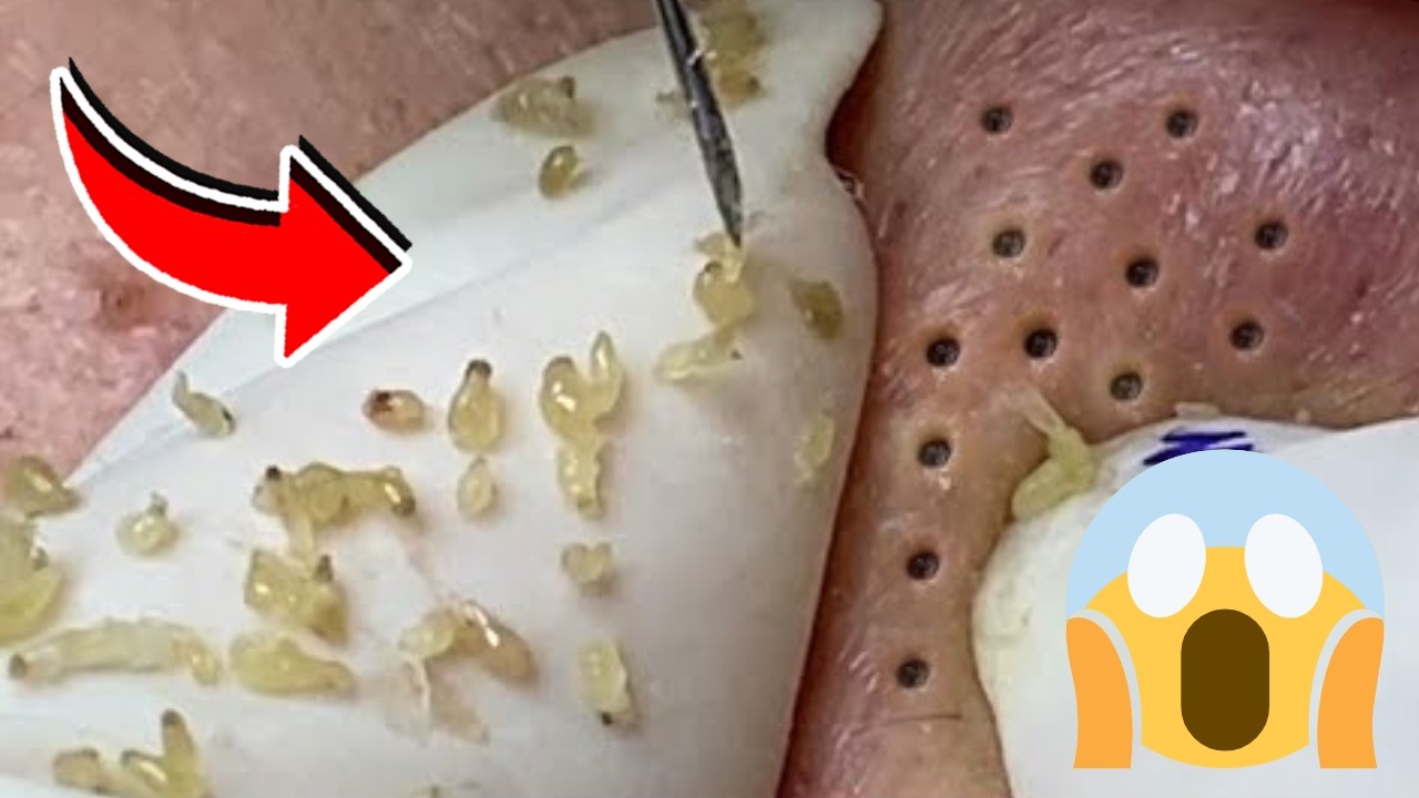 EXTRA&Ccedil;&Atilde;O DE CRAVOS SATISFAT&Oacute;RIA | LIMPEZA DE PELE COMENTADA POR ESTETICISTA! #356423