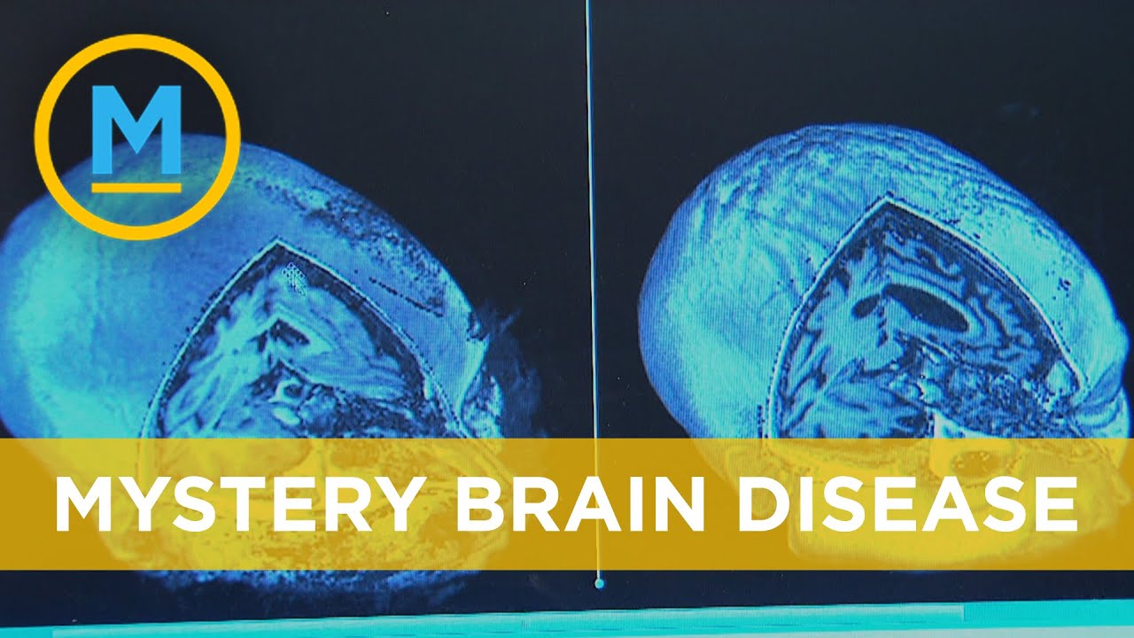 Mysterious fatal brain disease appearing in New Brunswick | Your Morning