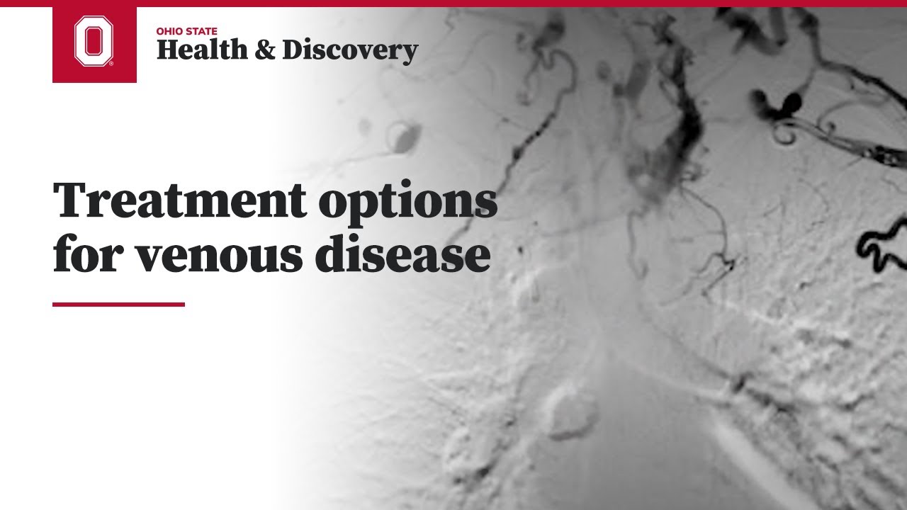 Treatment options for venous disease | Ohio State Medical Center