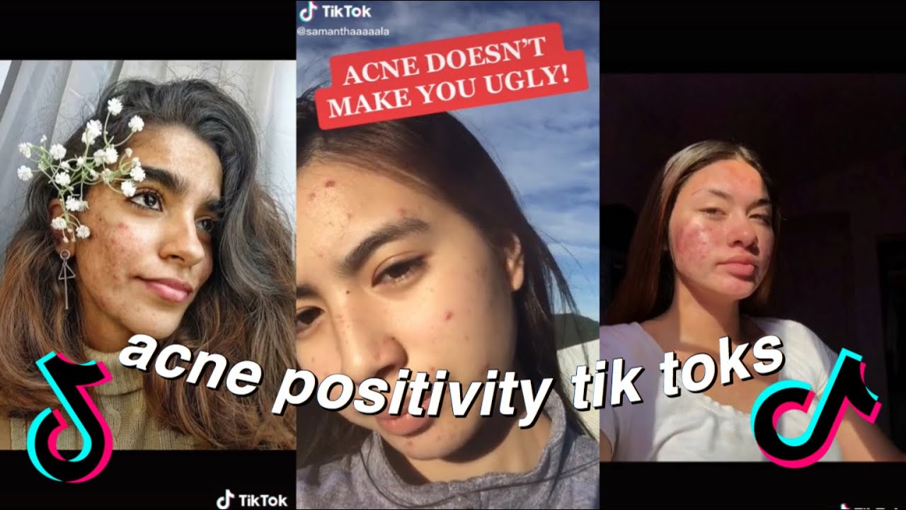 ACNE POSITIVITY TIKTOK COMPILATION | BODY POSITIVITY TIKTOK COMPILATION