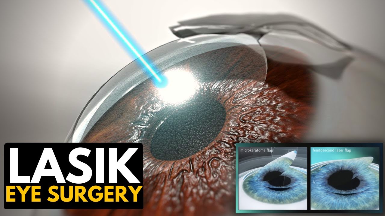 Lasik Eye Surgery: Everything You Need to Know.