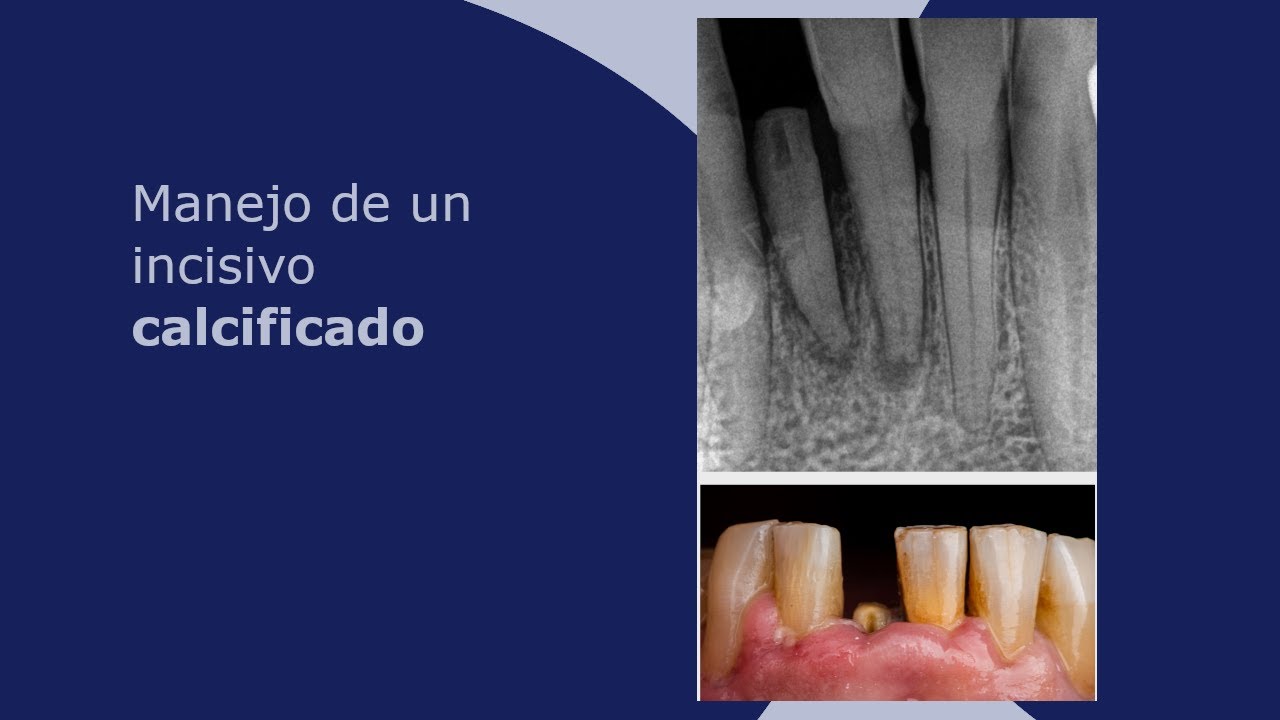 Manejo de un incisivo calcificado
