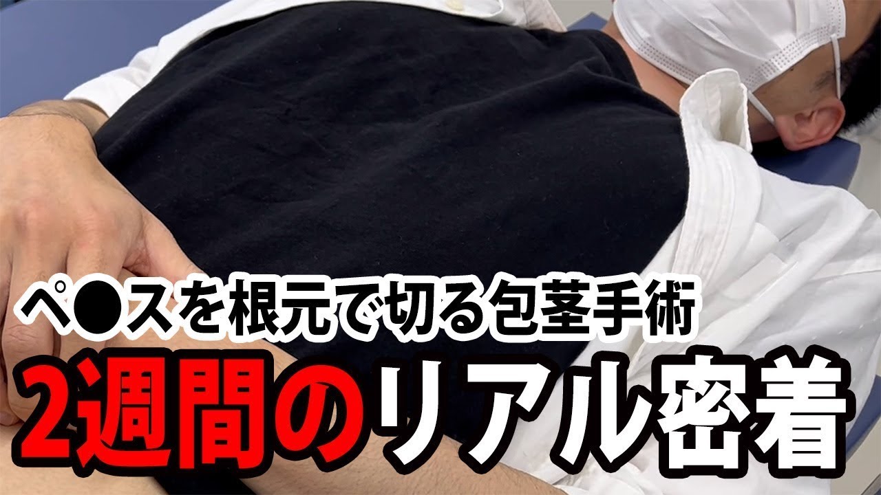 【日本では珍しい】ペ◯スを根元で切る包茎手術｜根部切開法【2週間後】