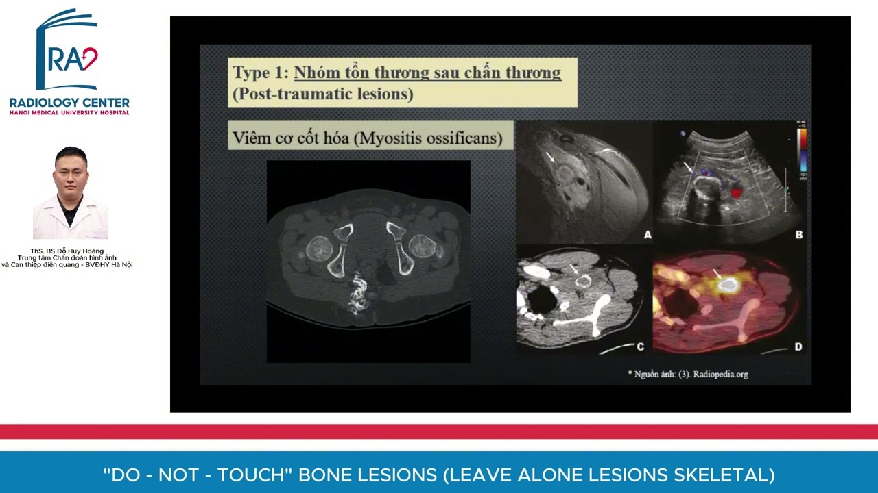 DO - NOT - TOUCH BONE LESIONS (LEAVE ALONE LESIONS SKELETAL- CÁC TỔN THƯƠNG XƯƠNG 
