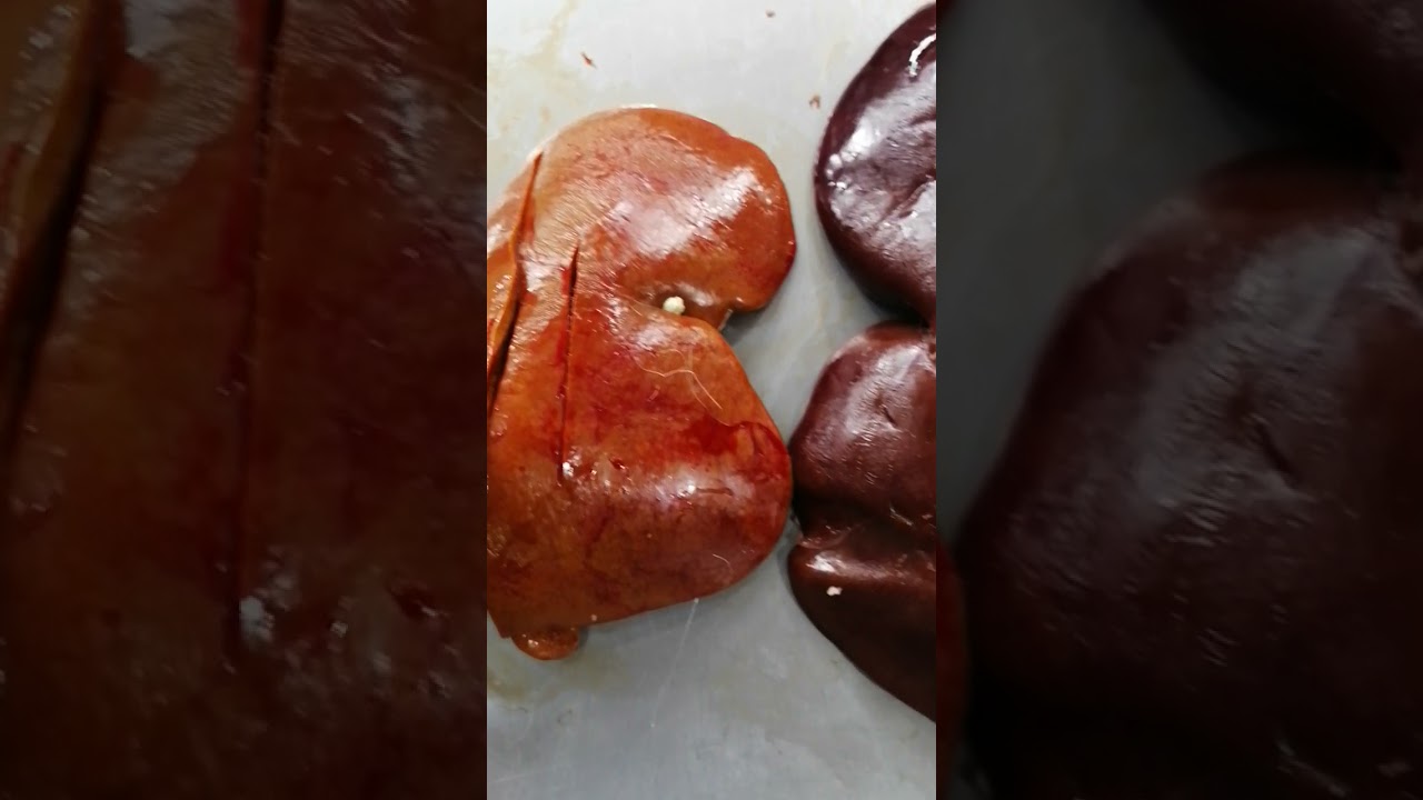 شرح عملي للكبده السليمه والتانيه المريضه👆👆👆#كبدة