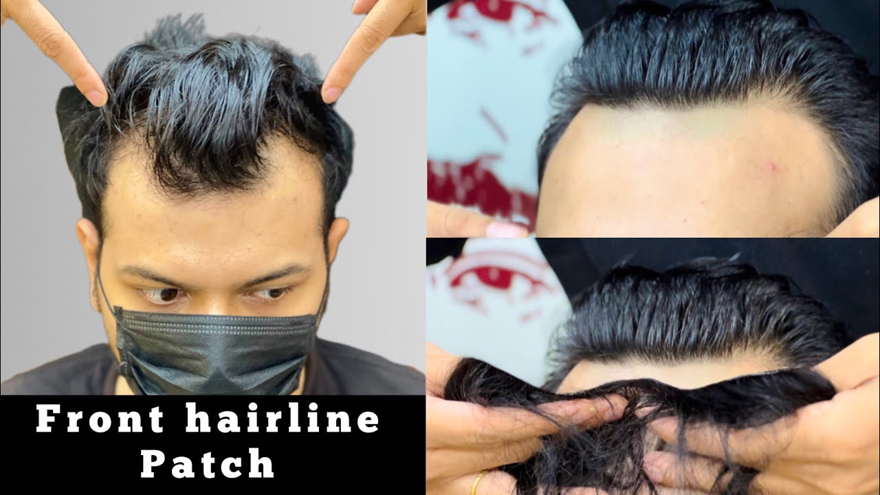Frontline Hair Patch For Men in Delhi | Amazing Hair Replacement Process | Call Us : 9650914665