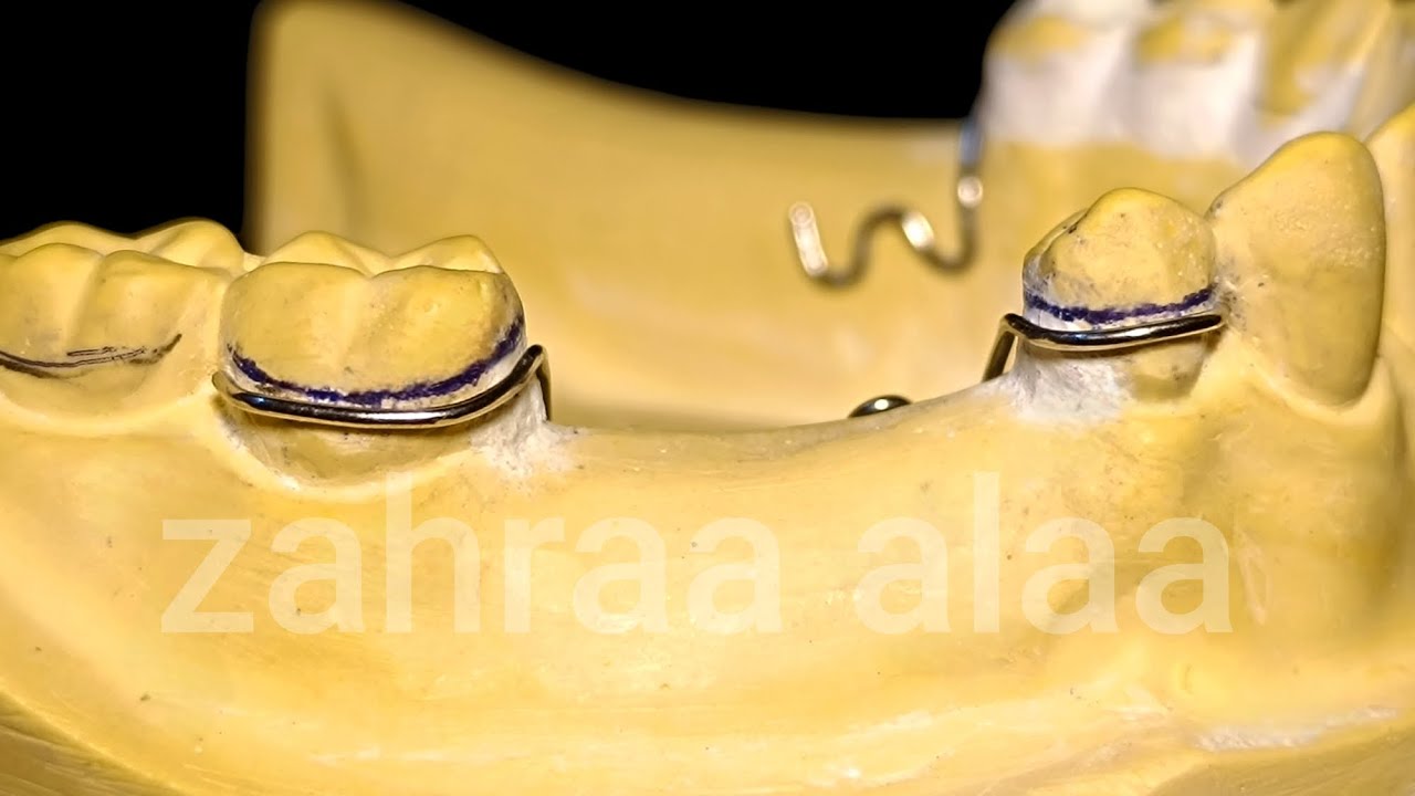 طب أسنان مرحلة ثالثة / طريقة عمل الكلاسبات / د. زهراء علاء