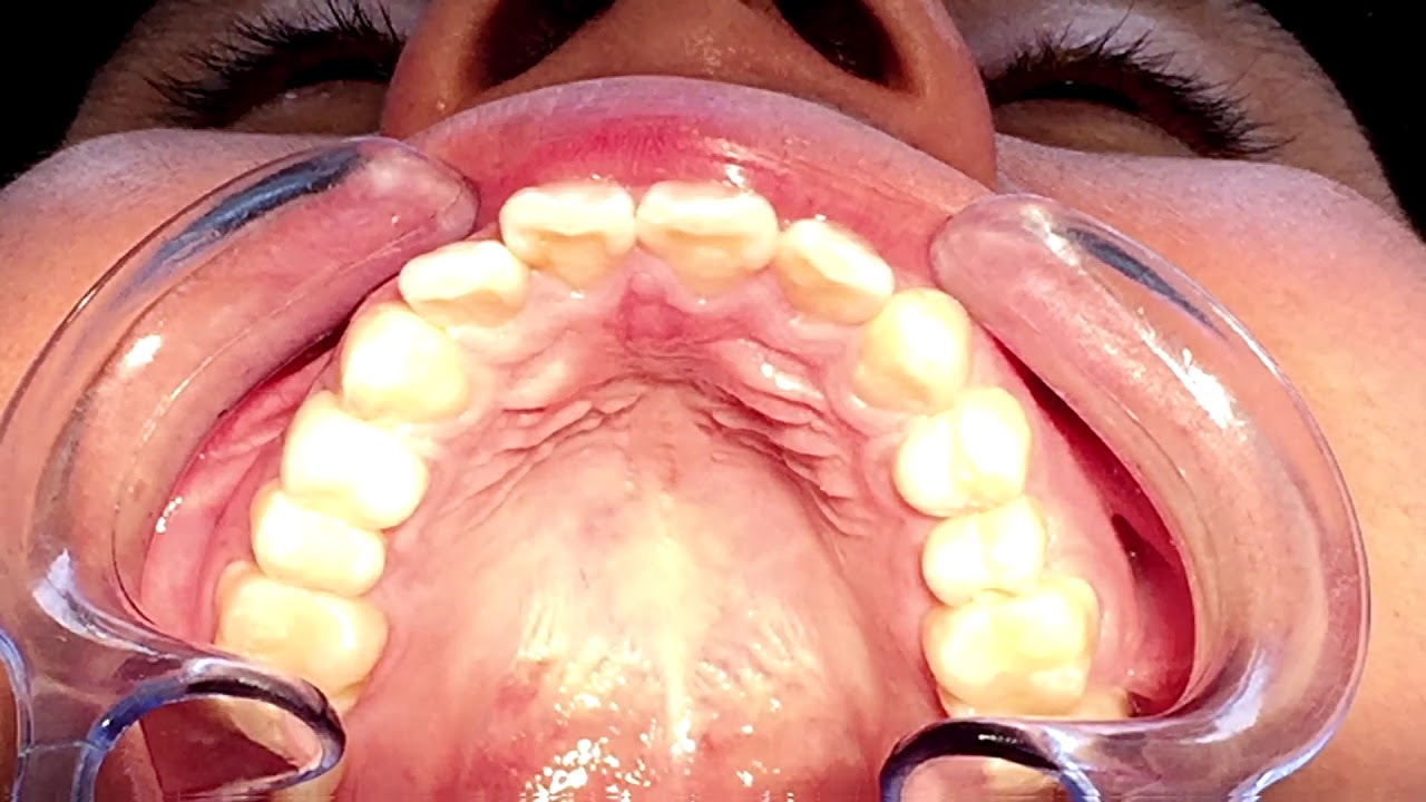 Aprendiendo a Anestesiar con Septodont (Scandonest, Medicaine, Septoject, Septoject XL)