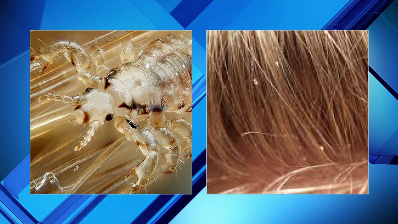 How to prevent and treat head lice