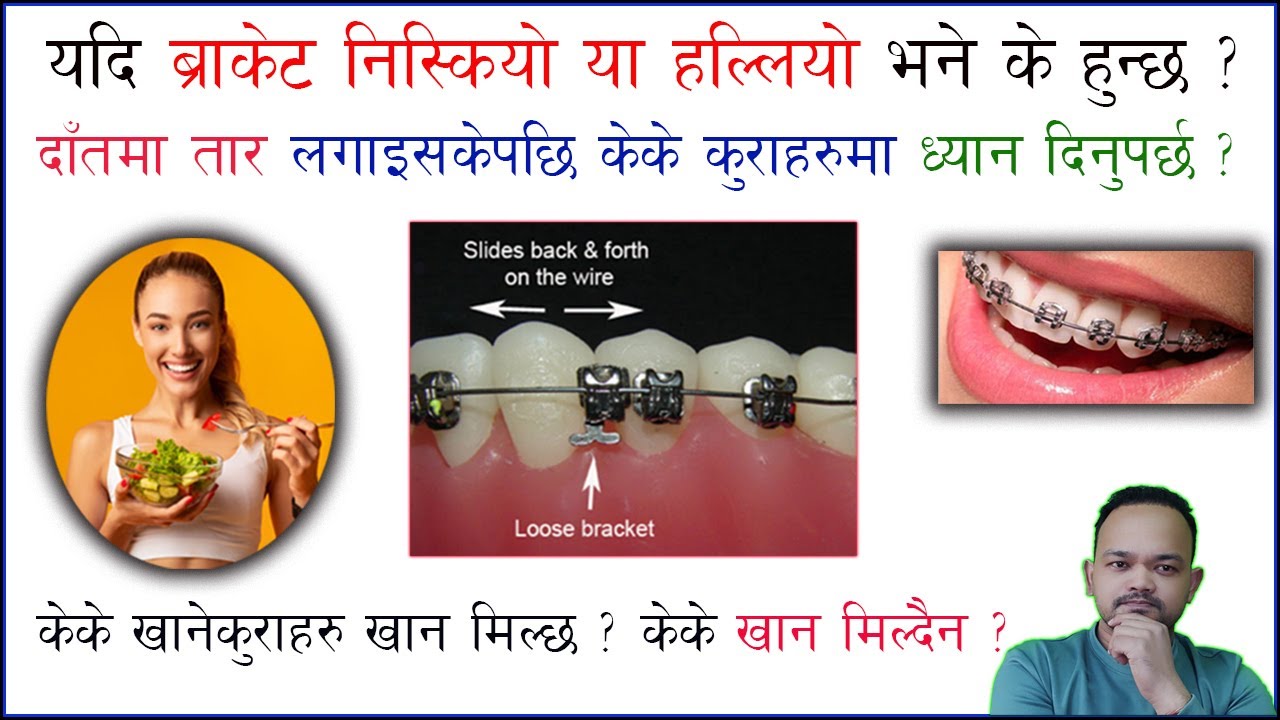 Braces instructions/ दाँतमा तार लगाएपछि केके कुरामा ध्यान दिनुपर्छ?/केके खान मिल्छ/मिल्दैन?/Doc Taj