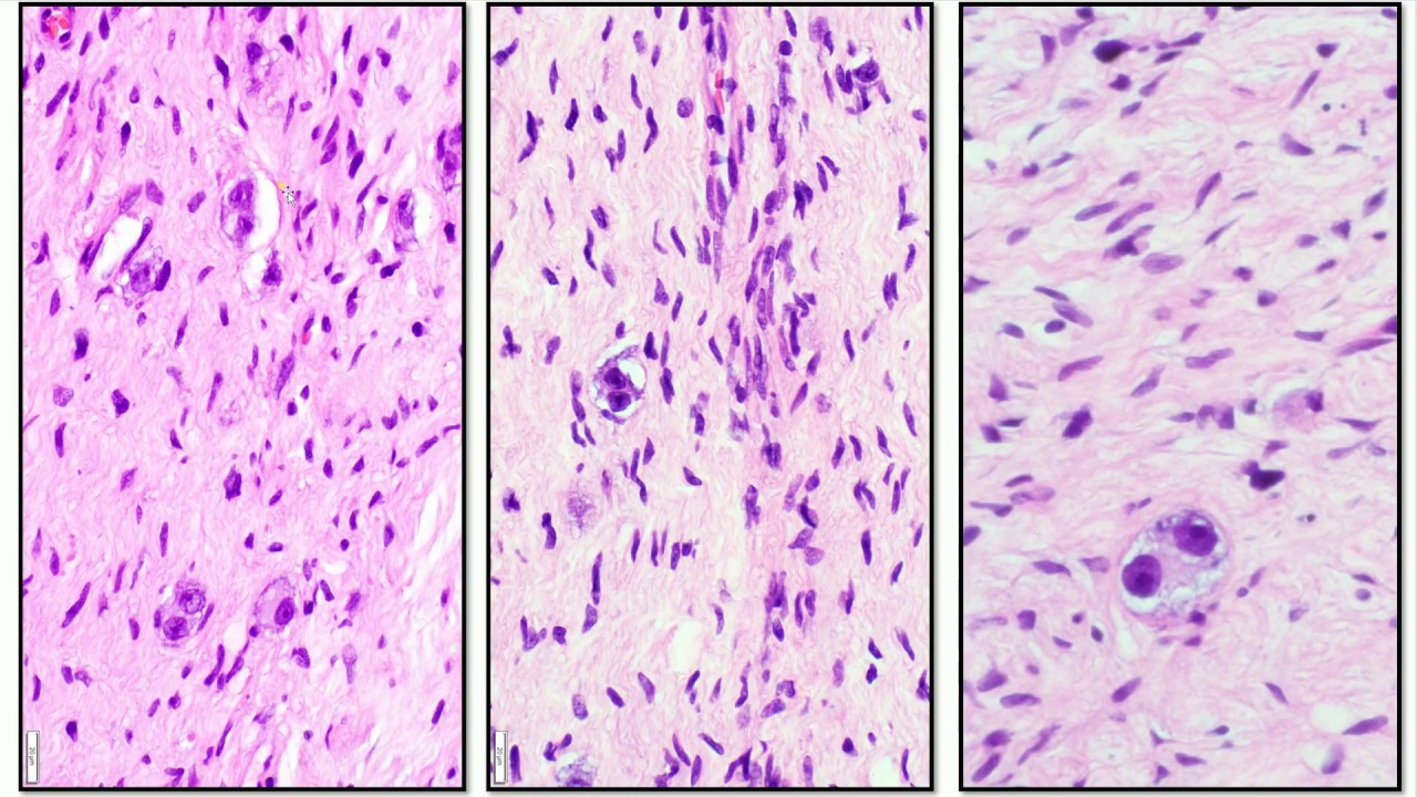 Neuroblastoma and Ganglioneuroma  - Adventures in Neuropathology