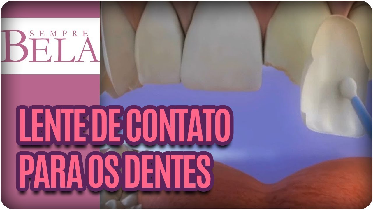 O que são as lentes de contato para os dentes?- Sempre Bela (19/11/17)