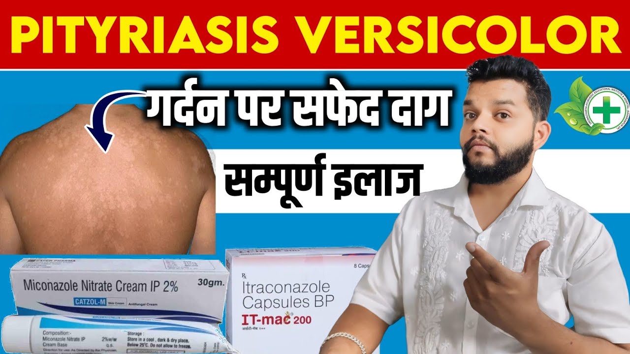 गर्दन पर सफेद दाग धब्बे का इलाज | Pityriasis Versicolor Causes, Symptoms And Treatment