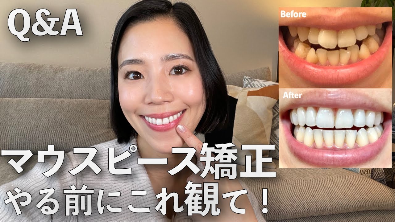 歯列矯正を検討してる人に観てほしい！皆さんからの質問に答えます