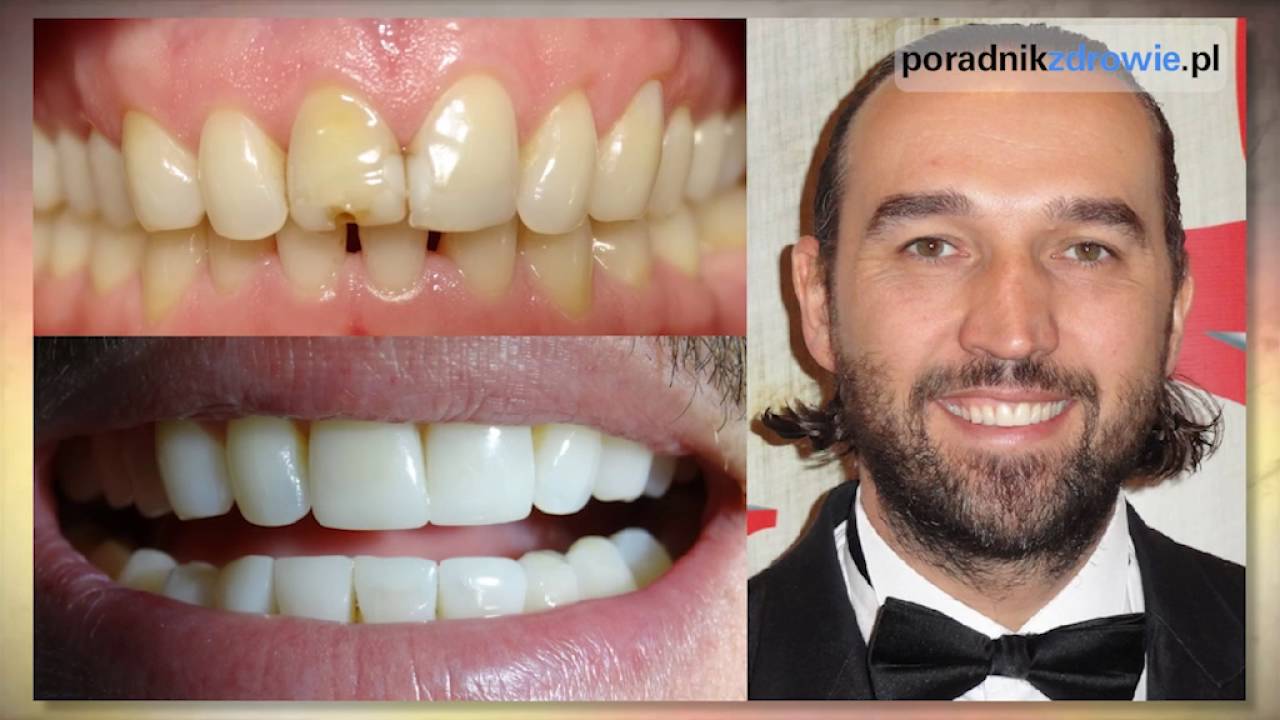 Co to jest bonding? Poznaj szybki spos&oacute;b na metamorfozę uśmiechu
