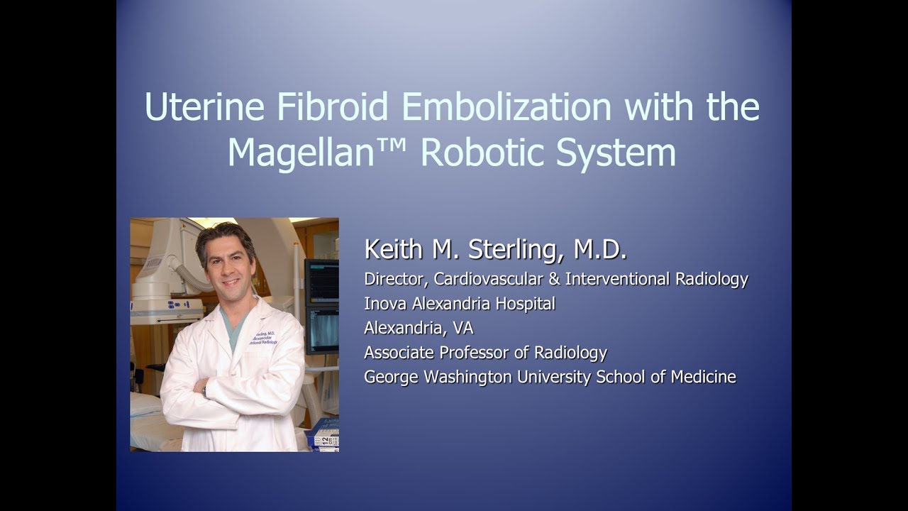 What is Uterine Fibroid Embolization (UFE)?