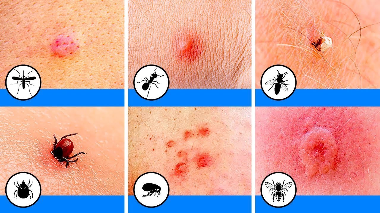 10 Insektenstiche, die jeder identifizieren können sollte