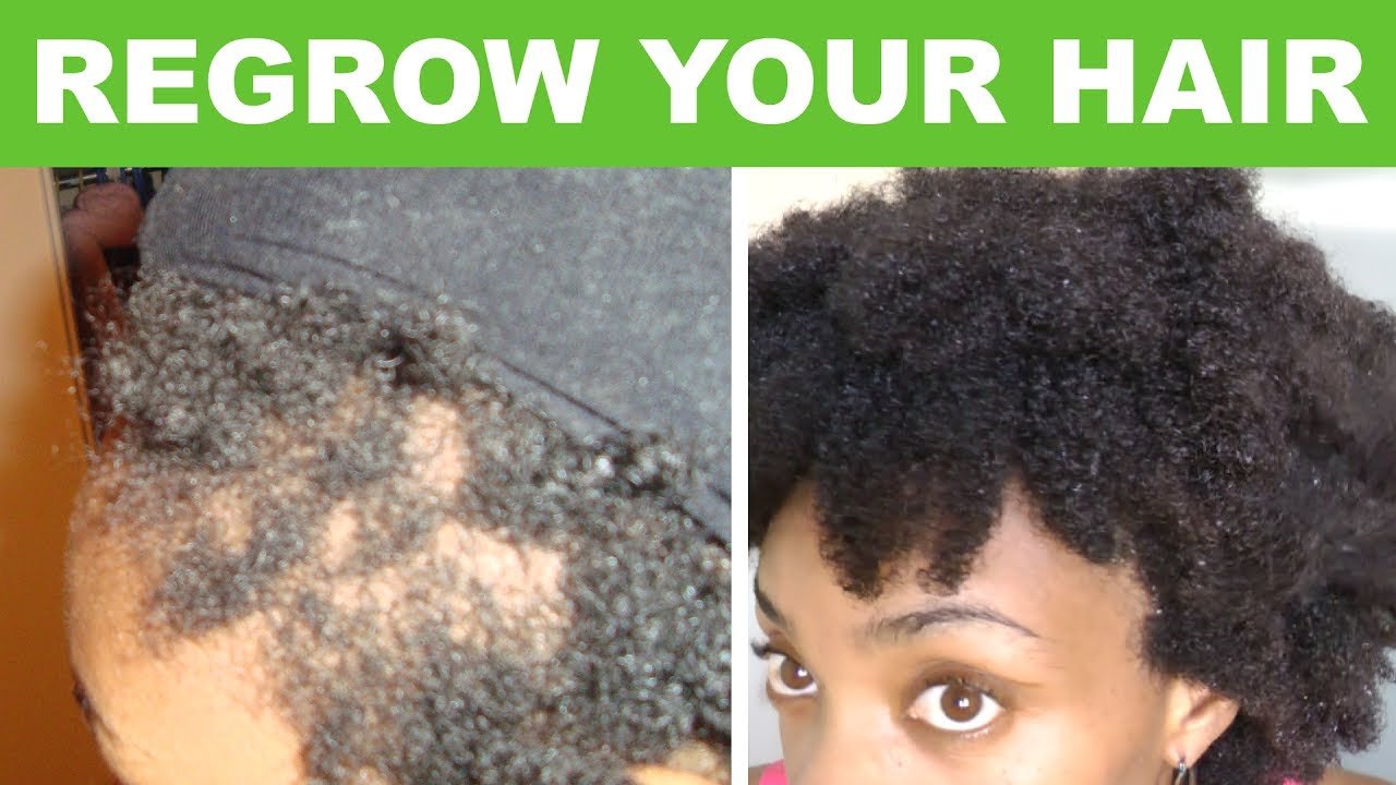 Regrow Your Hair - Traction Alopecia and Hair Loss (2017)