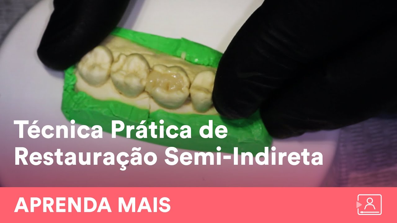 Restauração Semi-Indireta de Onlays e Inlays SEM SAIR do Consultório!