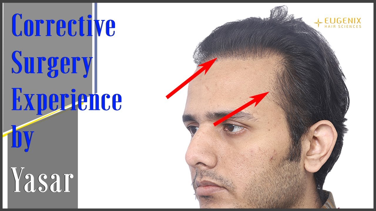 Planning & Surgery Experience of Yasar's Corrective Surgery @EugenixHairSciencesofficial