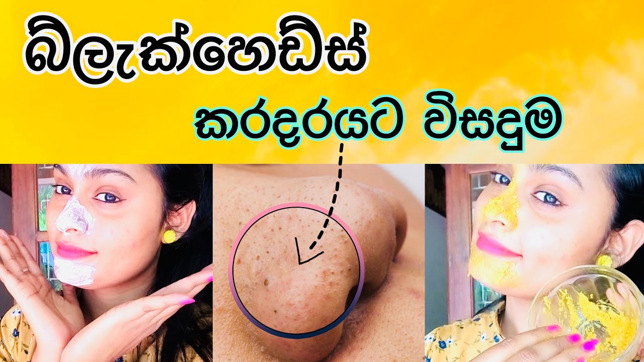 බ්ලැක්හෙඩ්ස් වයිට්හෙඩ්ස් කරදරයට හොදම විසදුම් 3ක් | How to Remove Blackheads Naturally