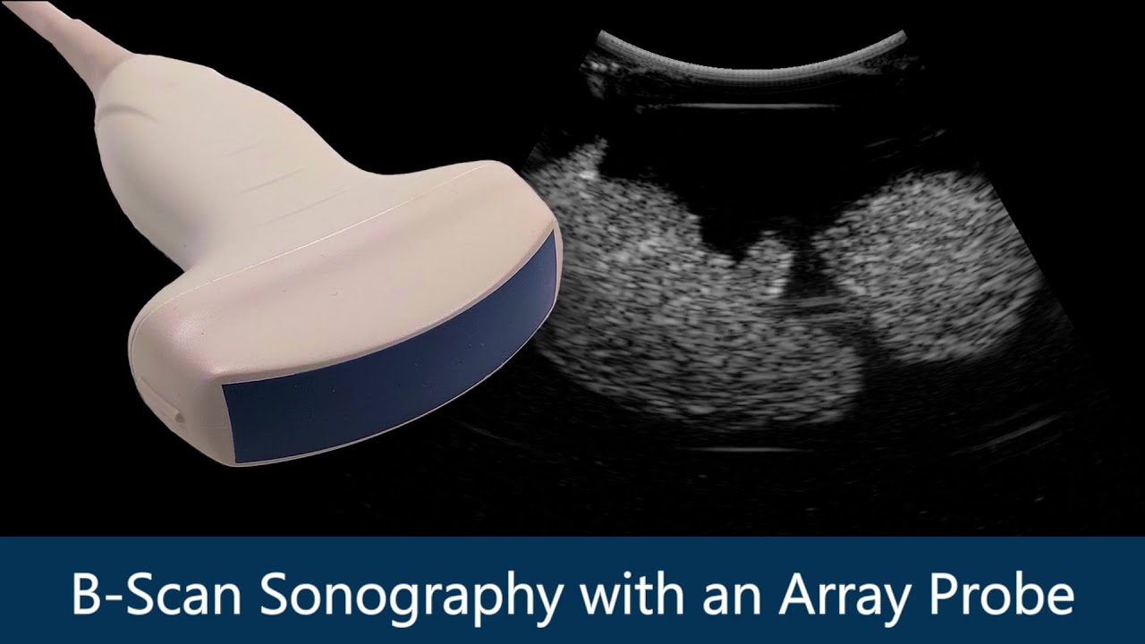 B-Scan Sonography with an Array Probe