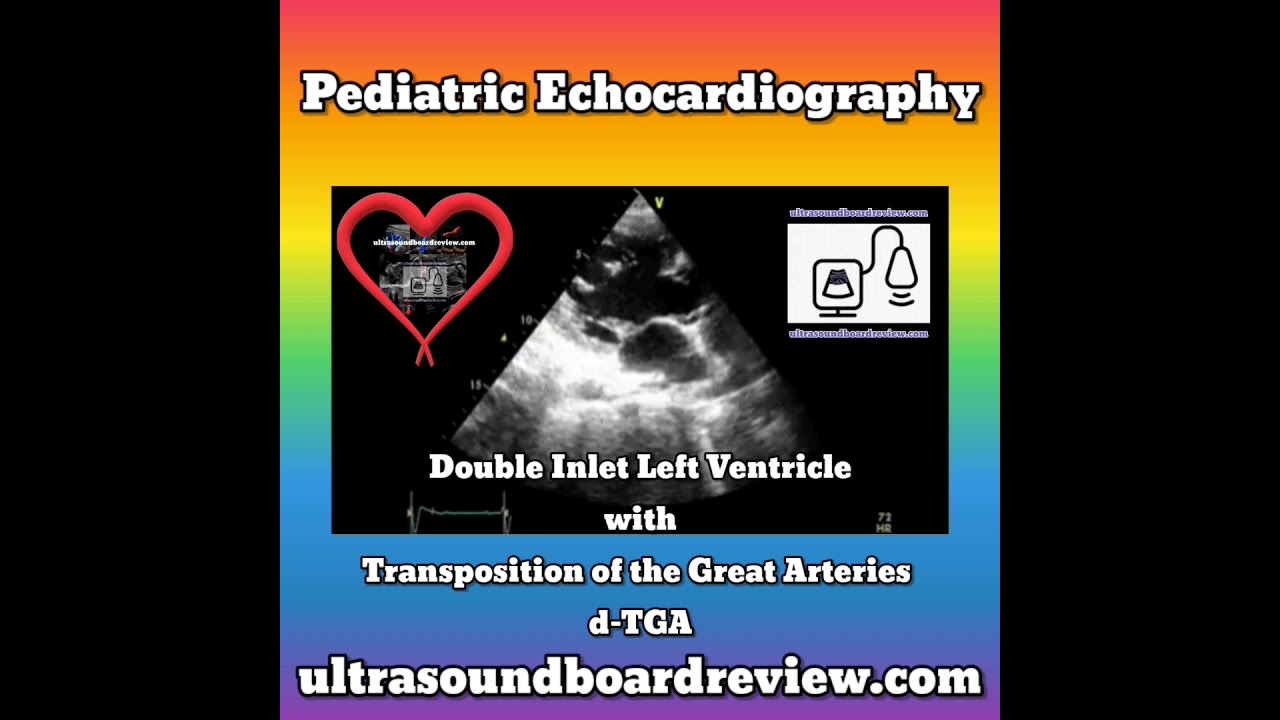 Double Inlet Left Ventricle