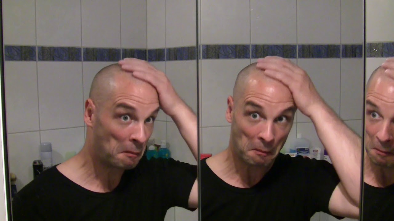 Haarausfall...ja und!? Dann rasiere ich mir eben eine Glatze!
