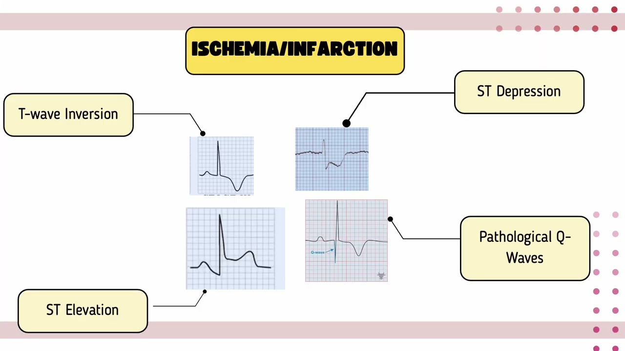 Reading Any ECG in 30 Seconds  module 1