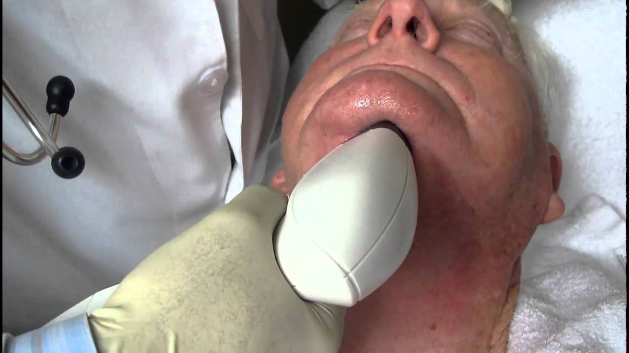 Facial Skin Tightening using Viora Reaction RF CORE