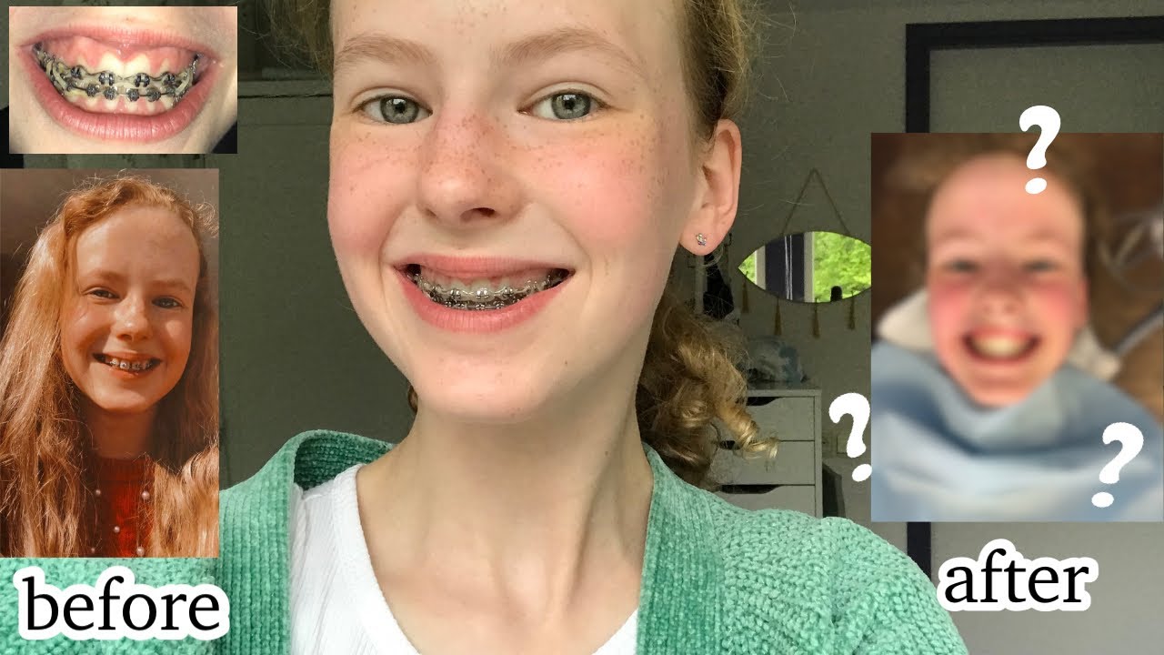 YESSS, mijn beugel gaat eruit! #vlog