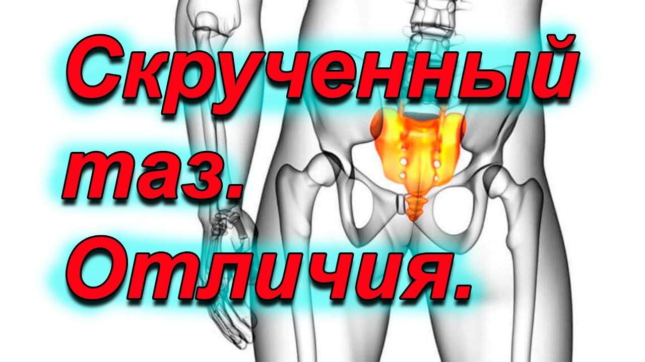 Скрученый таз. Как отличить от открытого таза.