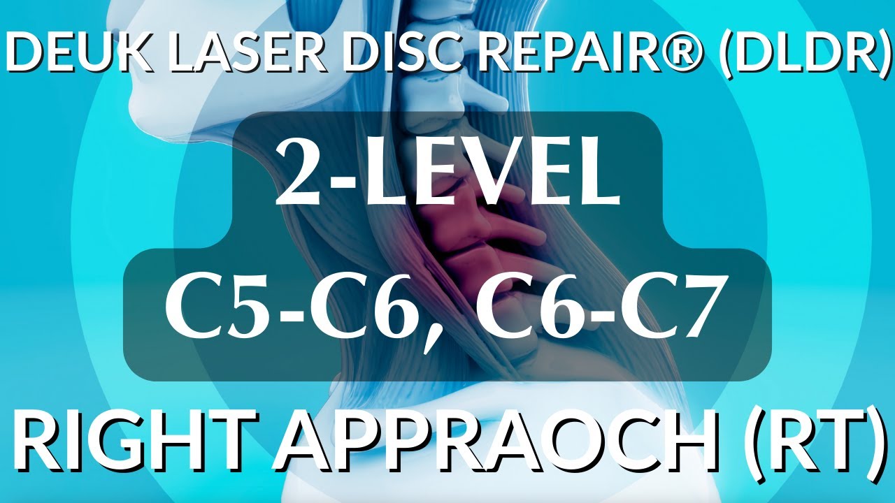 PLASMA RHIZOTOMY ON THE SI JOINT - LIVE - Laser Spine Surgery