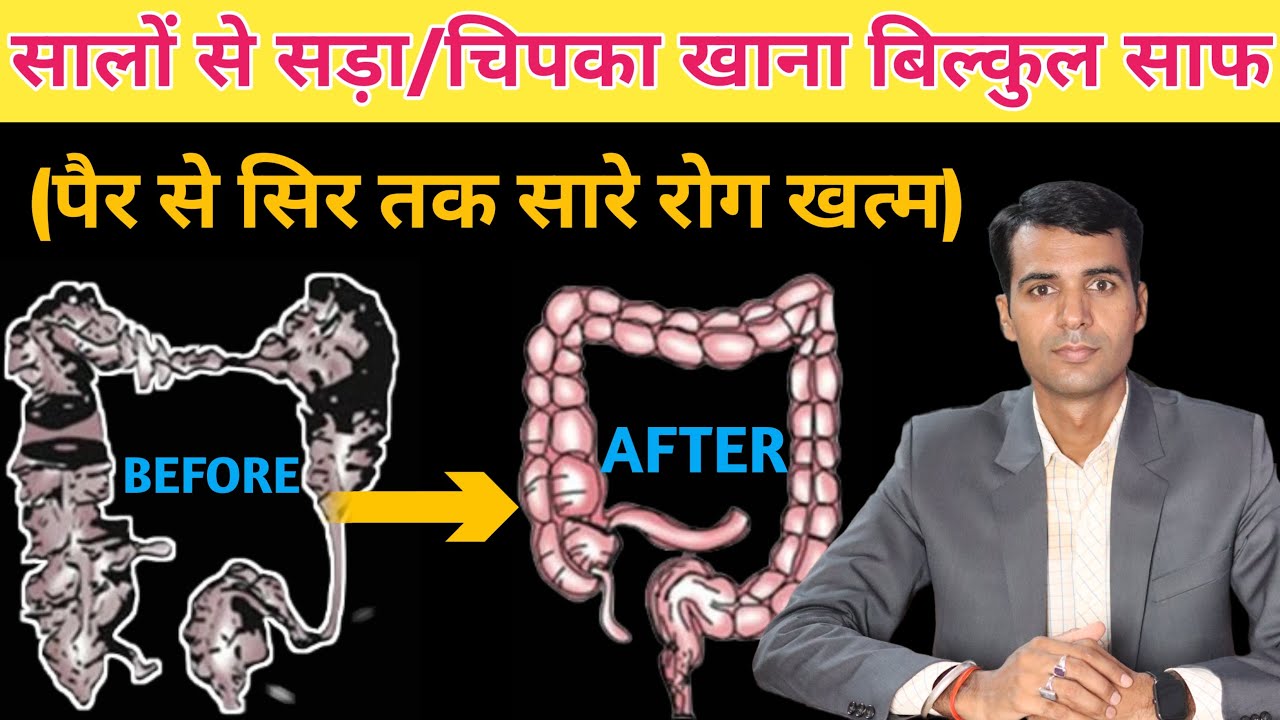 Detox Your Colon Immediately ? आँतों से चिपका मल निकालने का आसान तरीका !