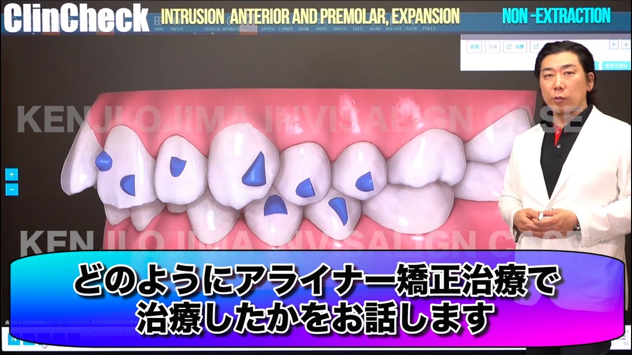 【症例解説】バイトランプを活用する過蓋咬合治療ー交叉咬合
