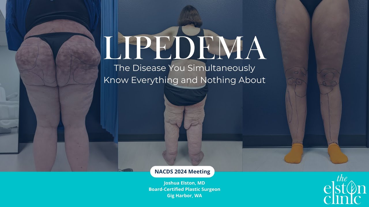 Lipedema: The Disease You Simultaneously Know Everything and Nothing About - Dr. Elston Presentation