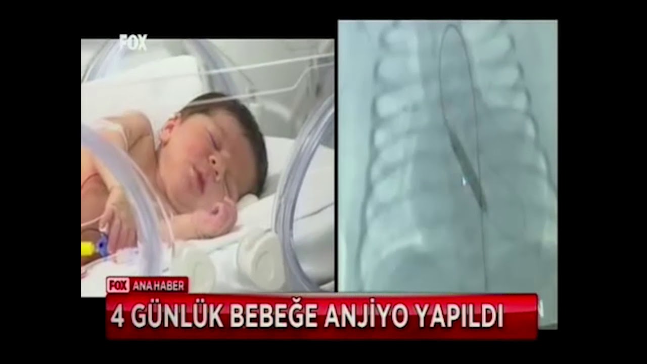 4 Günlük Bebeğe Anjiyo Yapıldı!