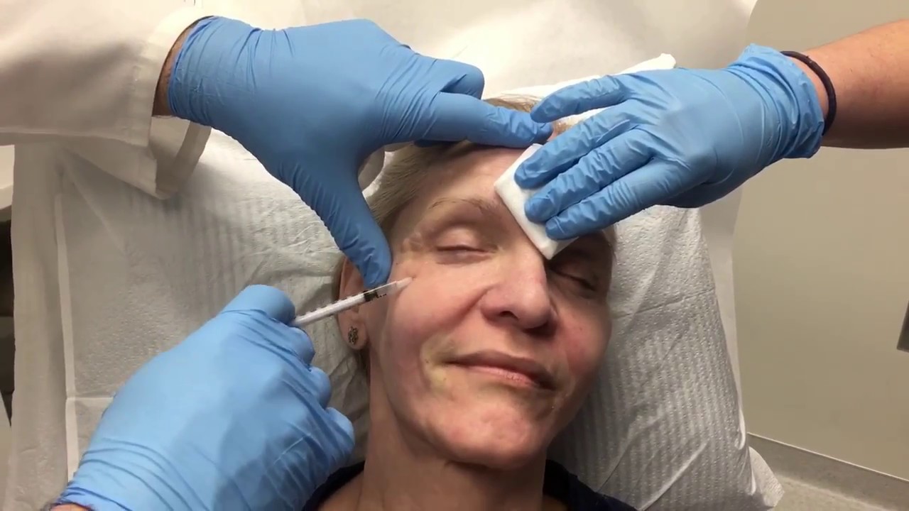 Live Restylane Refyne & Restylane Defyne Injections