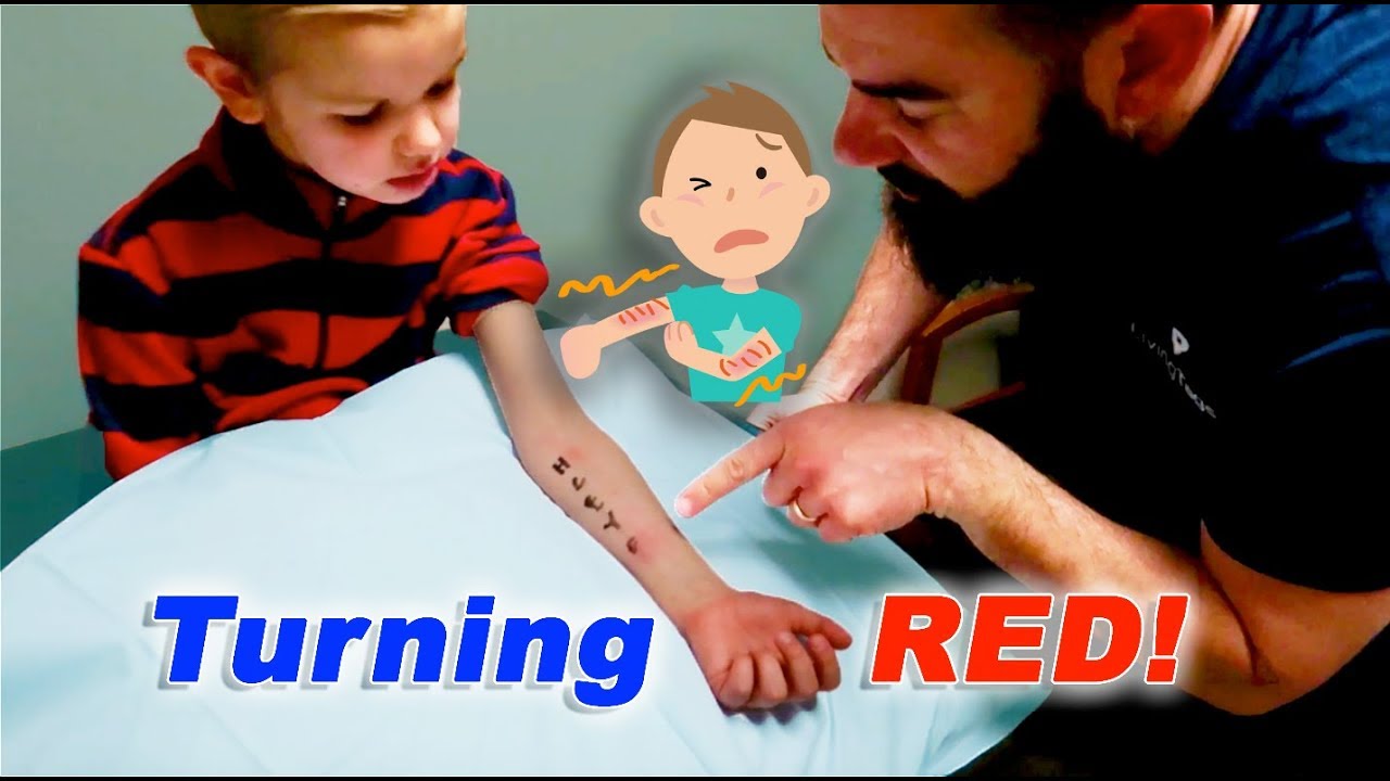 Allergy SKIN Test And Branson's Birthday!