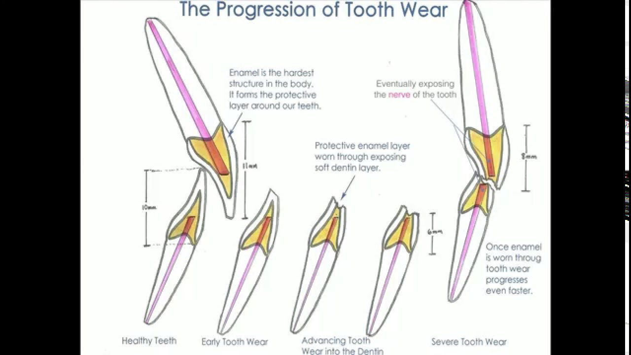 Tooth Wear and Tooth Erosion - Dr George Olstein Dentist Melbourne