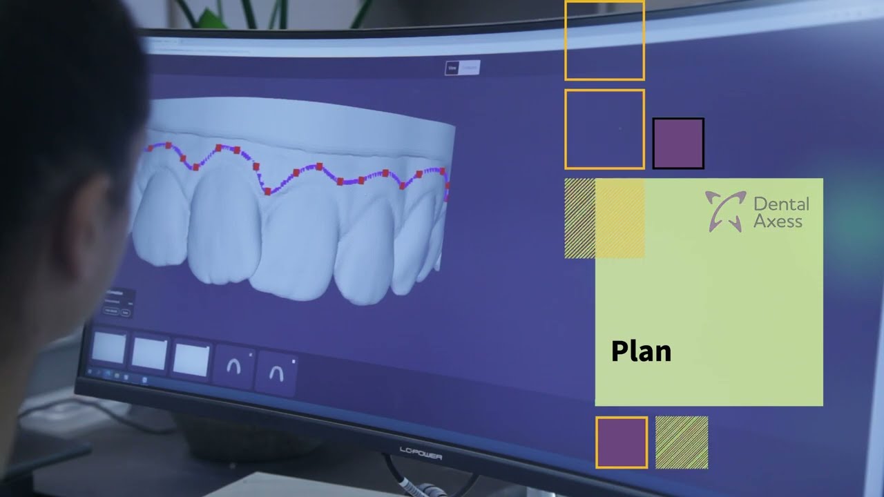 Full in-house clear aligner workflow - 5 easy steps