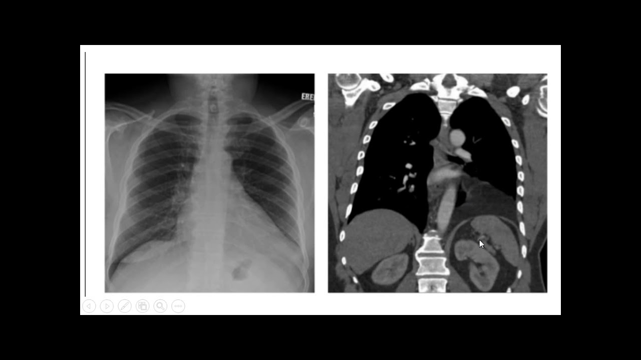 mediastinal masses