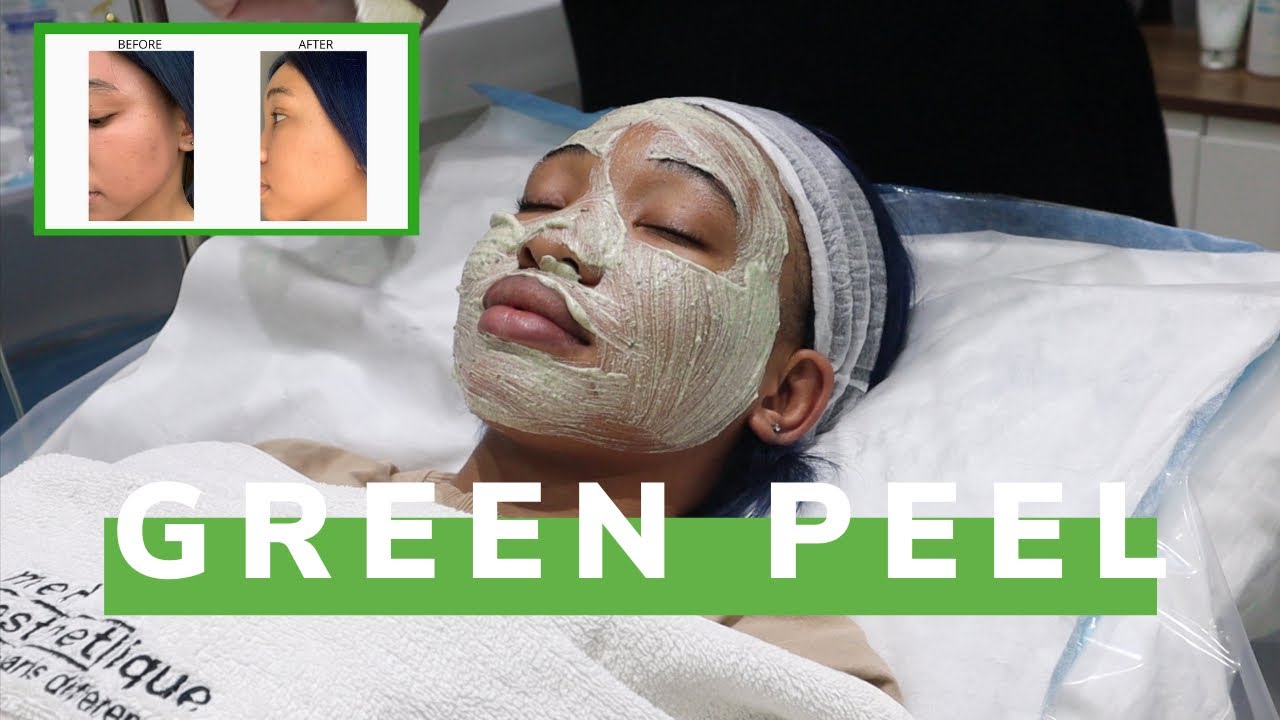 Getting Rid Of Dark Marks/Hyperpigmentation Fast With A Green Peel